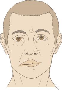 Facial Palsy Diagram